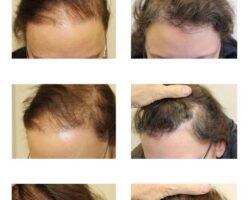 Financing Your Hair Transplant: Budgeting for Your New Look