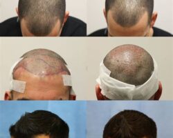 Preparing for a Hair Transplant: What to Expect Before, During, and After the Procedure