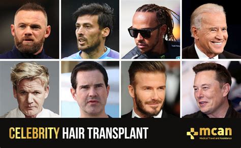 Celebrity Hair Transplants: The Secrets Behind Their Flawless Looks