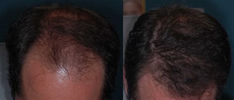 Hair Transplants: The Latest Innovations and Techniques in Hair Restoration